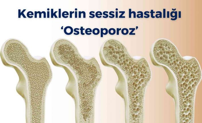 Kemiklerin sessiz hastalığı ‘osteoporoz’