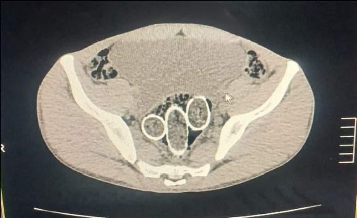 320 gram uyuşturucuyu mide ve rahme sakladılar