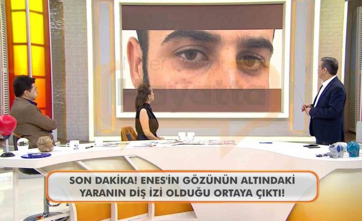 Canlı yayında Enes Güran’ın gözünün altındaki diş izine dikkat çekildi