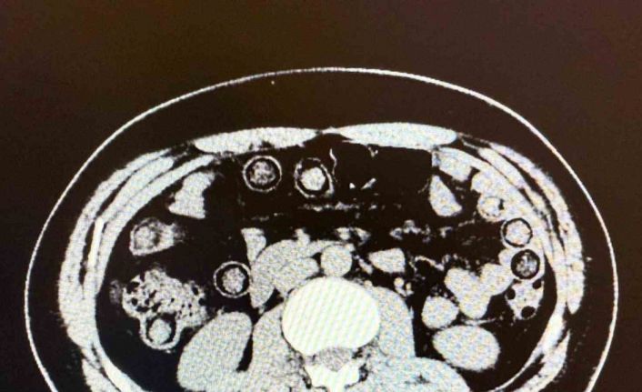 Muş’ta midelerinden 928 gram uyuşturucu çıkan 2 İranlı tutuklandı